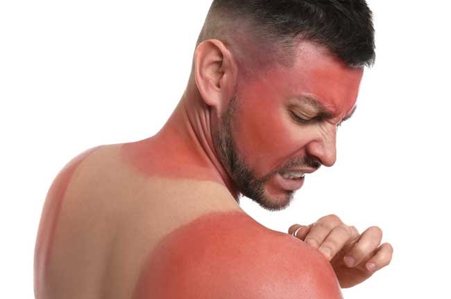 What are the Causes and Prevention of Sunburn?