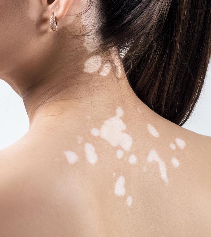 Treat white spots on your body with these 6 home remedies!