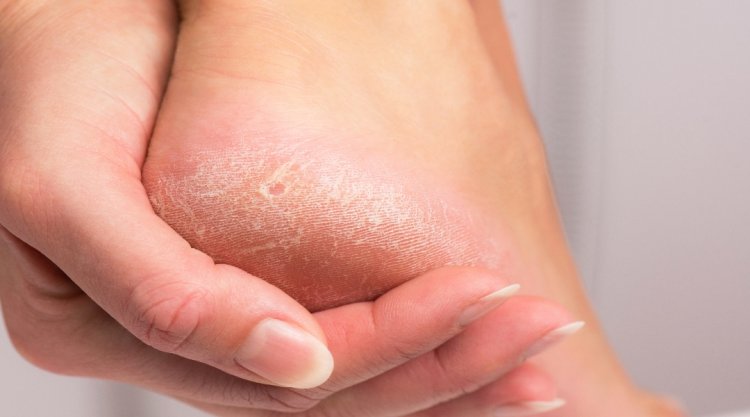 Cracked Heels: Are you worried about cracked heels in winter? So get rid of these methods