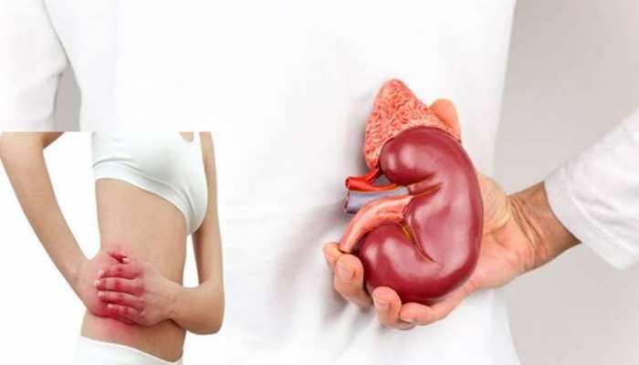 Kidney Disease: Kidney patients should not eat these foods even by mistake, otherwise there will be trouble