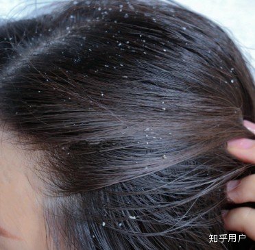 Dandruff Remedies: These 10 beneficial home remedies will get rid of the problem of dandruff in winter